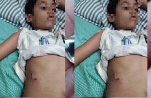 पेबल बे फेस 1, बागमुगलिया कटारा हिल्स में आवारा कुत्ते ने बच्चे को काटा