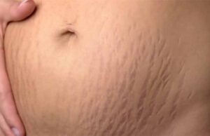 जिद्दी स्ट्रेच मार्क्स से छुटकारा पाने के आसान घरेलू उपाय