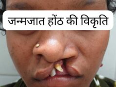 जन्मजात होंठ की विकृति का हुआ सफल उपचार, अब सामान्य जीवन जी रही हैं 22 वर्षीय युवती