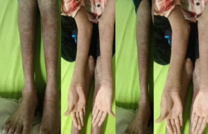 नामुमकिन हुआ मुमकिन! AIIMS रायपुर में ‘लाइलाज’ समझी जा रही बीमारी का सफल इलाज