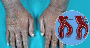 सिकल सेल को लेकर बस्तर में बड़ा अभियान, 6 लाख से अधिक लोगों की जांच